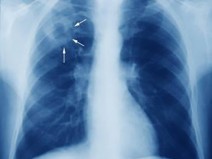 3 Doen�as que Previnem Outras Doen�as