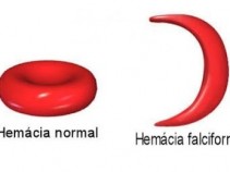 Anemia falciforme protege contra mal�ria
