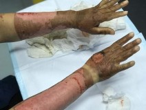 Foto mostra m�os queimadas ap�s o uso de �lcool em gel! Ser� verdade?